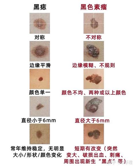 黑痣的形成|黑痣形成的原因是什么？它对人体有什么危害么？推不推荐把痣去。